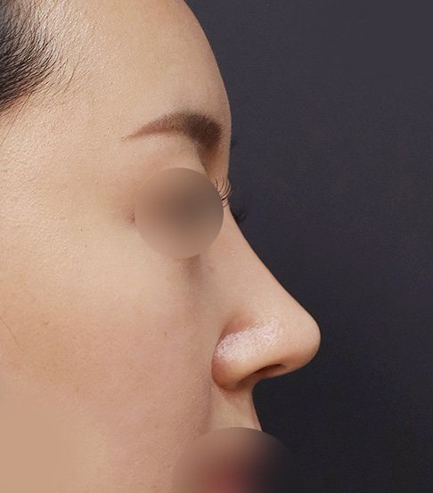 코재수술(콧대+코끝)+휜코교정+짧은코 수술후 1개월(옆모습)