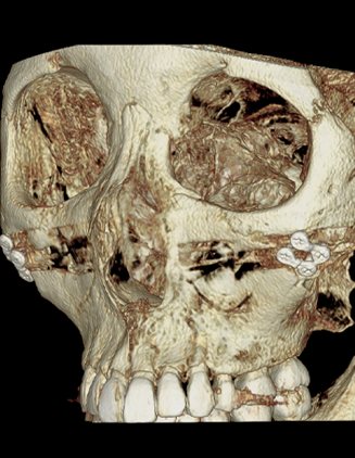코수술 전 3D-CT사진 — 3D-CT 입체 두개골(정면에서 약간 비스듬히) — 얼굴뼈·코뼈