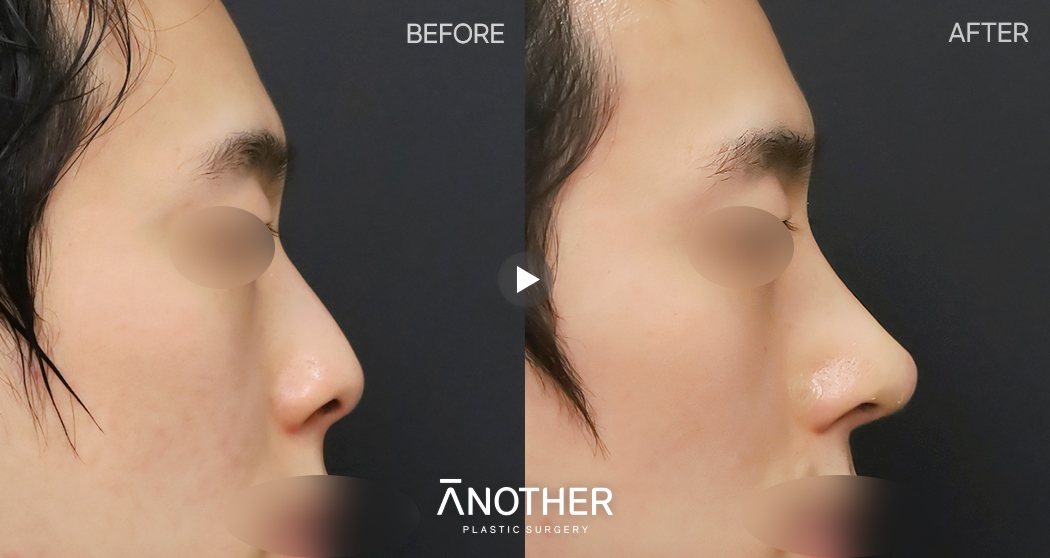 남자 코수술 수술후 1개월 — 옆모습 BEFORE·AFTER