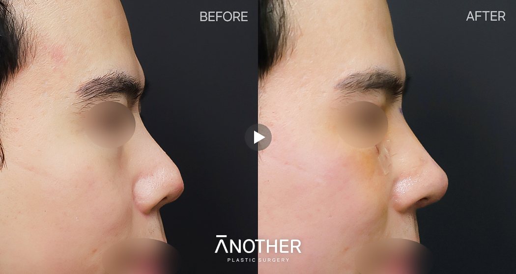 남자 코수술 수술후 1주 — 옆모습 BEFORE·AFTER