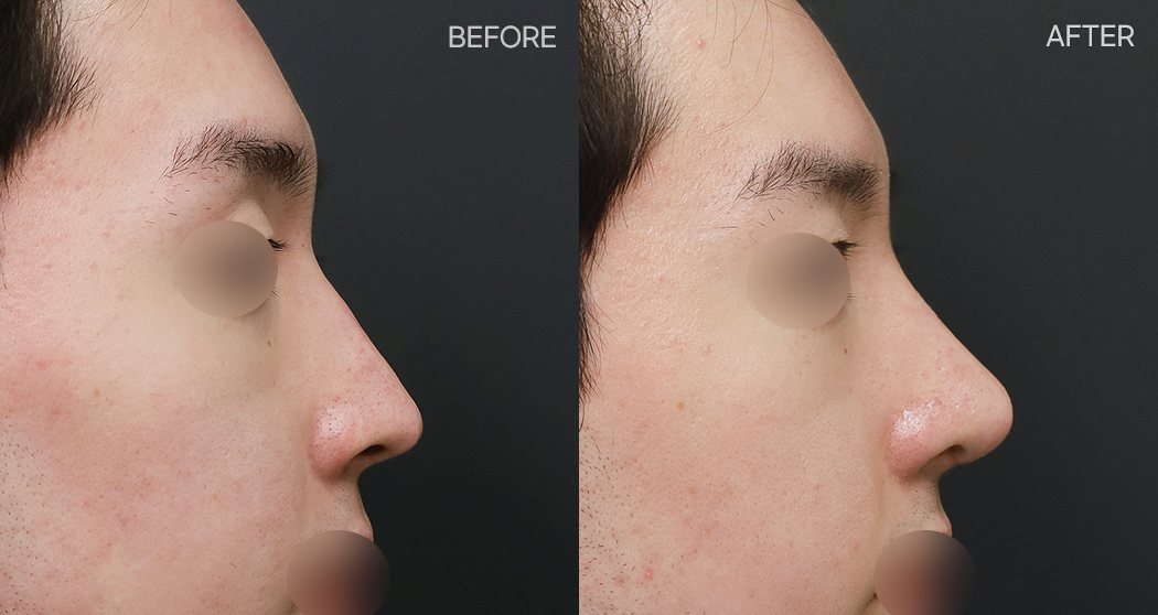 남자 코수술 수술후 1개월 — 옆모습 BEFORE·AFTER