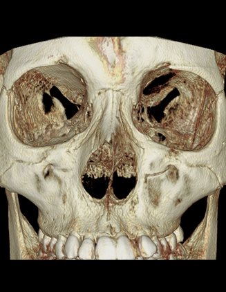 코수술 전 3D-CT사진 — 3D-CT 입체 두개골(정면) — 코뼈·비강