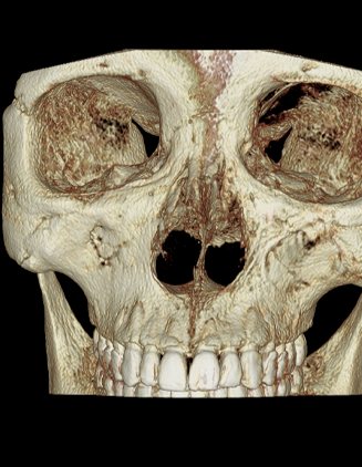 코수술 전 3D-CT사진 — 3D-CT 입체 두개골(정면) — 코뼈·비강